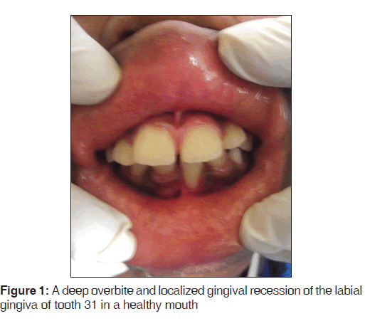 annals-medical-health-localized-gingival-recession
