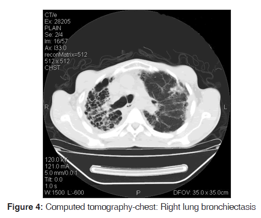 annals-medical-health-lung-bronchiectasis