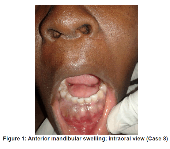 annals-medical-health-mandibular-swelling