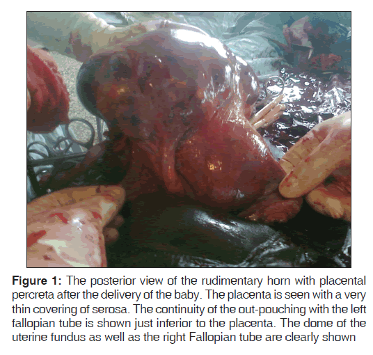 annals-medical-health-placental-percreta