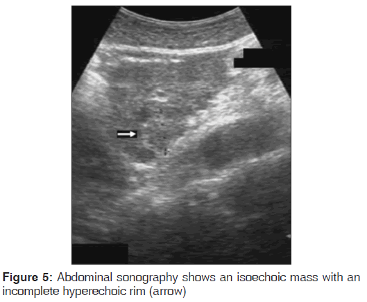 annals-medical-health-sciences-Abdominal-sonography-shows-isoechoic-mass