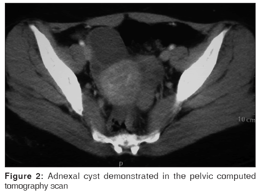 annals-medical-health-sciences-Adnexal-cyst