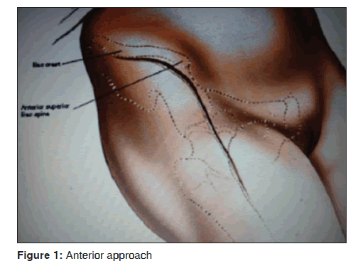 annals-medical-health-sciences-Anterior-approach