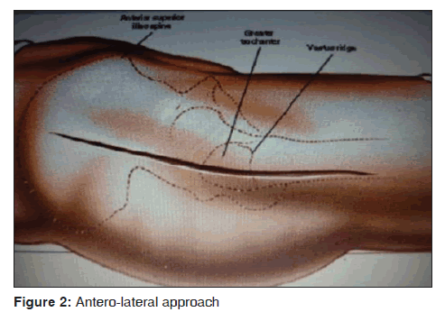 annals-medical-health-sciences-Antero-lateral