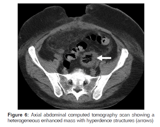 annals-medical-health-sciences-Axial-abdominal-computed-tomography-scan