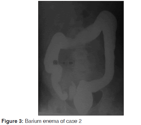 annals-medical-health-sciences-Barium-enema