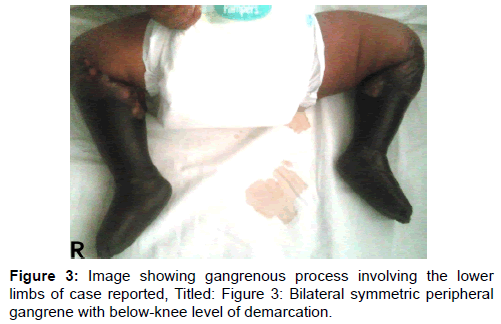annals-medical-health-sciences-Bilateral-symmetric-peripheral-gangrene
