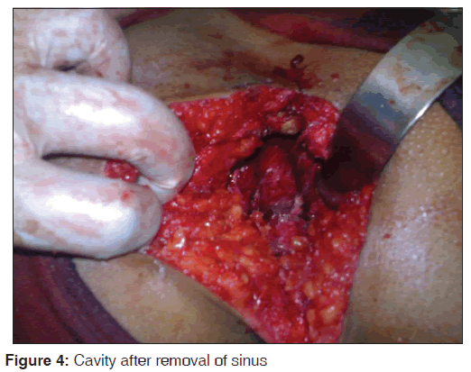 annals-medical-health-sciences-Cavity-removal-sinus