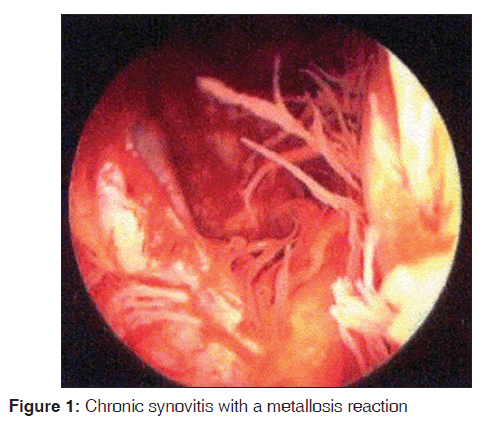 annals-medical-health-sciences-Chronic-synovitis-metallosis-reaction