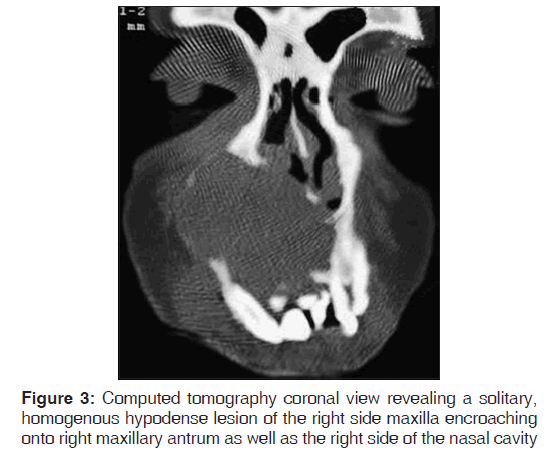 annals-medical-health-sciences-Computed-tomography-coronal-view