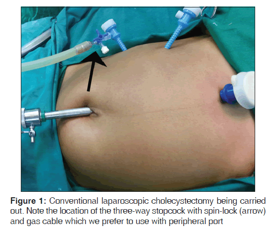 annals-medical-health-sciences-Conventional-laparoscopic-cholecystectomy
