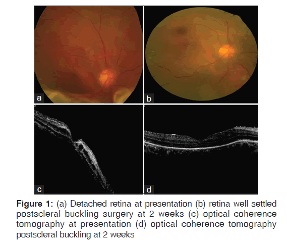 annals-medical-health-sciences-Detached-retina