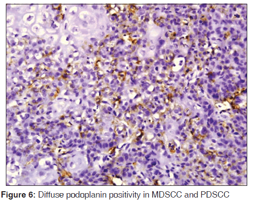 annals-medical-health-sciences-Diffuse-podoplanin