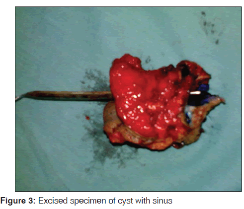 annals-medical-health-sciences-Excised-specimen-cyst-sinus