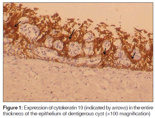 annals-medical-health-sciences-Expression-cytokeratin