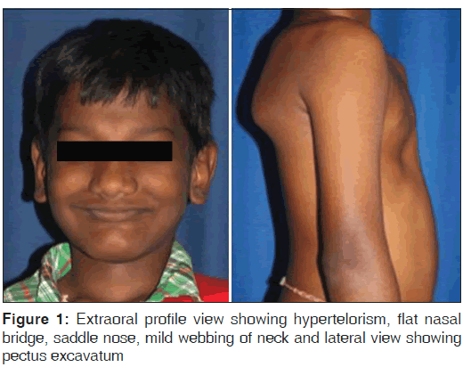 annals-medical-health-sciences-Extraoral-profile
