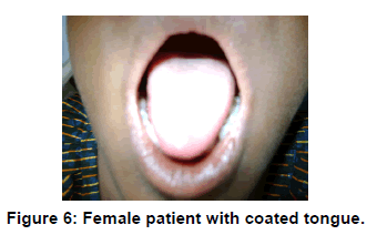 annals-medical-health-sciences-Female-patient-coated-tongue