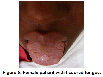 annals-medical-health-sciences-Female-patient-fissured-tongue