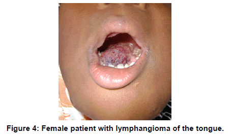annals-medical-health-sciences-Female-patient-lymphangioma-tongue