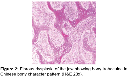 annals-medical-health-sciences-Fibrous-dysplasia