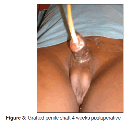 annals-medical-health-sciences-Grafted-penile