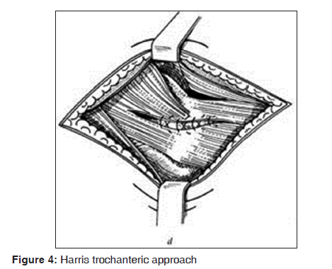 annals-medical-health-sciences-Harris-trochanteric