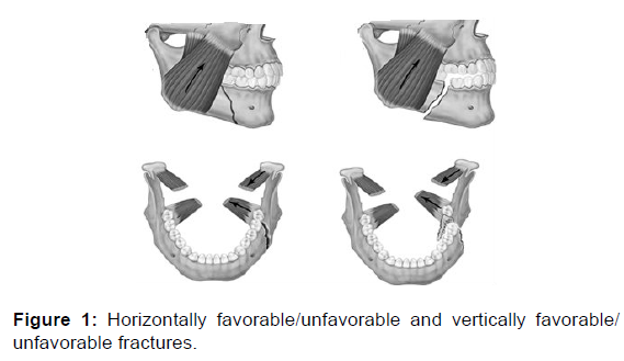 Newer Proposed Classification of Mandibular Fractures: A Critica