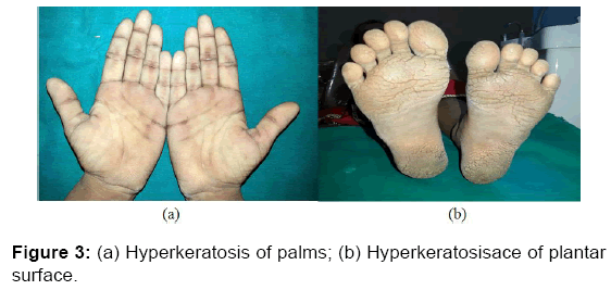 annals-medical-health-sciences-Hyperkeratosis-palms