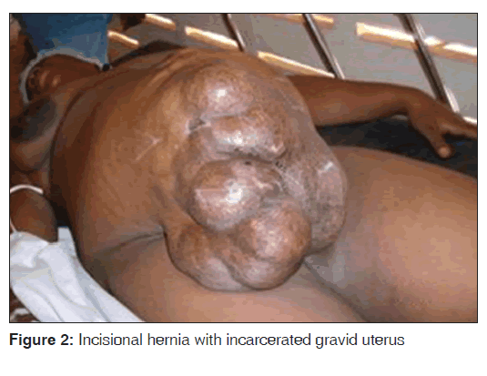 annals-medical-health-sciences-Incisional-hernia