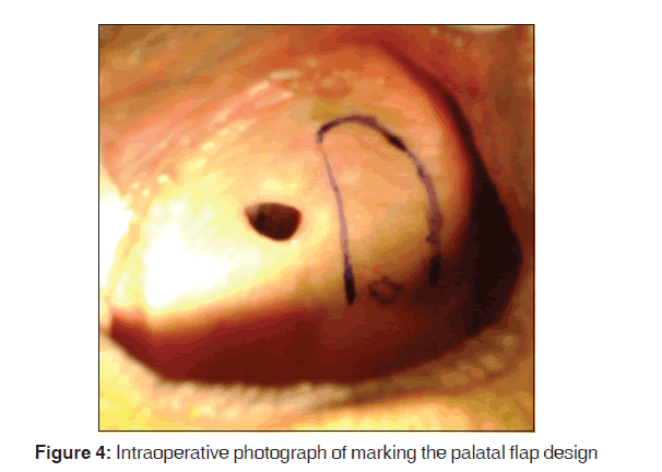 annals-medical-health-sciences-Intraoperative