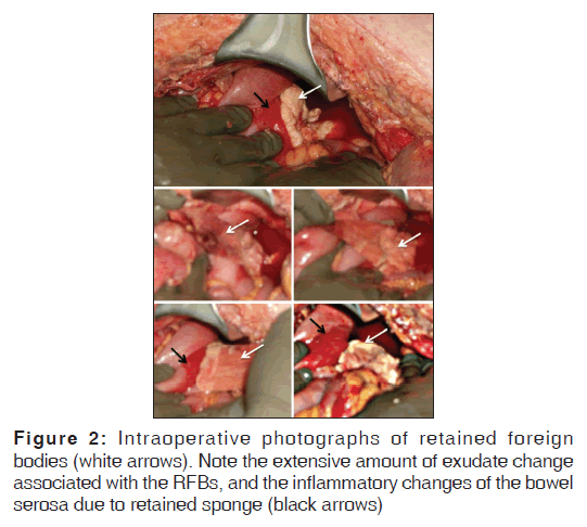 annals-medical-health-sciences-Intraoperative-photographs-retained