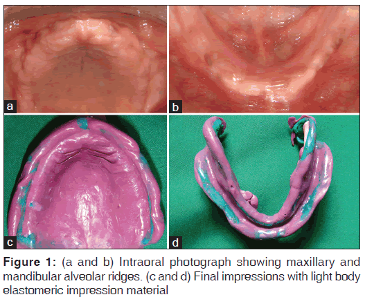 annals-medical-health-sciences-Intraoral-photograph