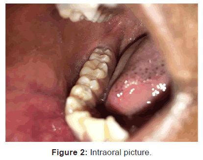 annals-medical-health-sciences-Intraoral-picture