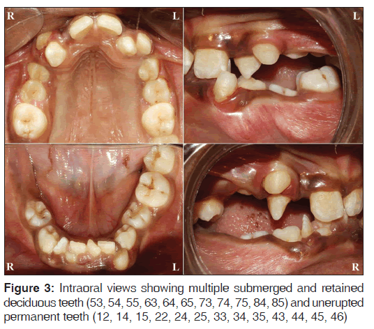 annals-medical-health-sciences-Intraoral-views