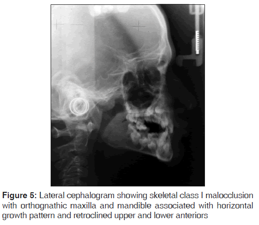 annals-medical-health-sciences-Lateral-cephalogram