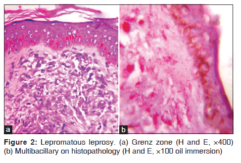 annals-medical-health-sciences-Lepromatous-leprosy-Grenz-zone