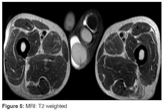 annals-medical-health-sciences-Scrotalsonography-reveals-three-testes