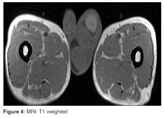 annals-medical-health-sciences-Scrotalsonography-reveals-three-testes