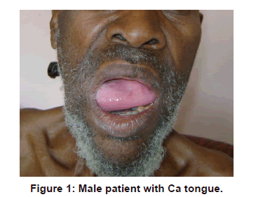 annals-medical-health-sciences-Male-patient-Ca-tongue