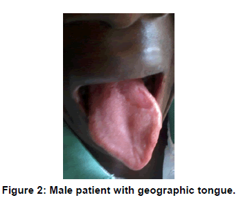 annals-medical-health-sciences-Male-patient-geographic-tongue