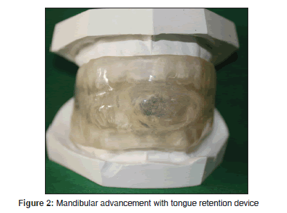 annals-medical-health-sciences-Mandibular-advancement