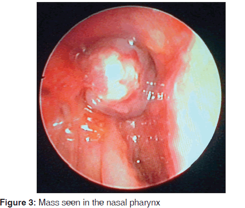 annals-medical-health-sciences-Mass-seen