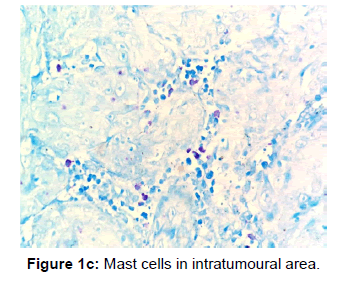 annals-medical-health-sciences-Mast-cells-intratumoural-area