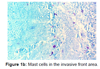 annals-medical-health-sciences-Mast-cells-invasive-front-area