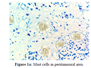 annals-medical-health-sciences-Mast-cells-peritumoural-area