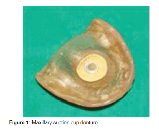 annals-medical-health-sciences-Maxillary