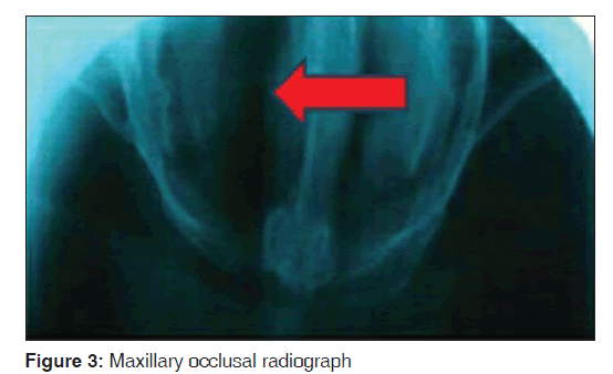 annals-medical-health-sciences-Maxillary-occlusal-6-2-129-g003