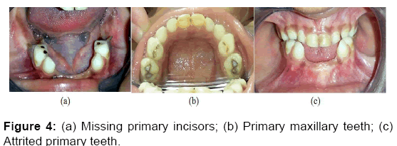 annals-medical-health-sciences-Missing-primary