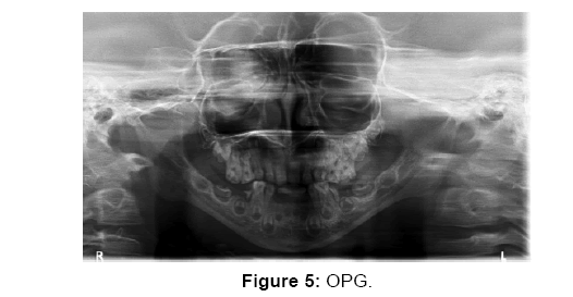 annals-medical-health-sciences-OPG