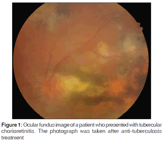 annals-medical-health-sciences-Ocular-fundus